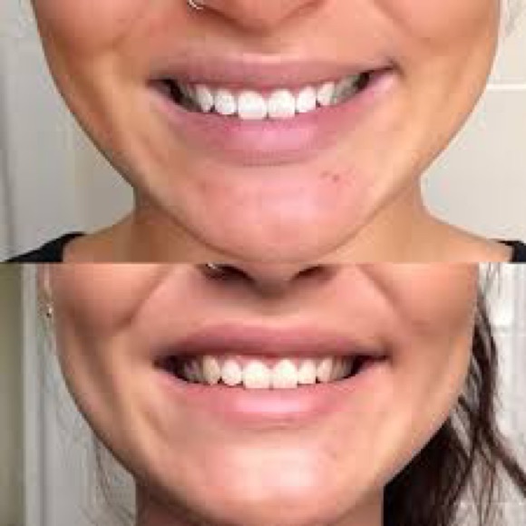 HiSmile Whiting Kit with 9 Refills - Picture 2 of 8